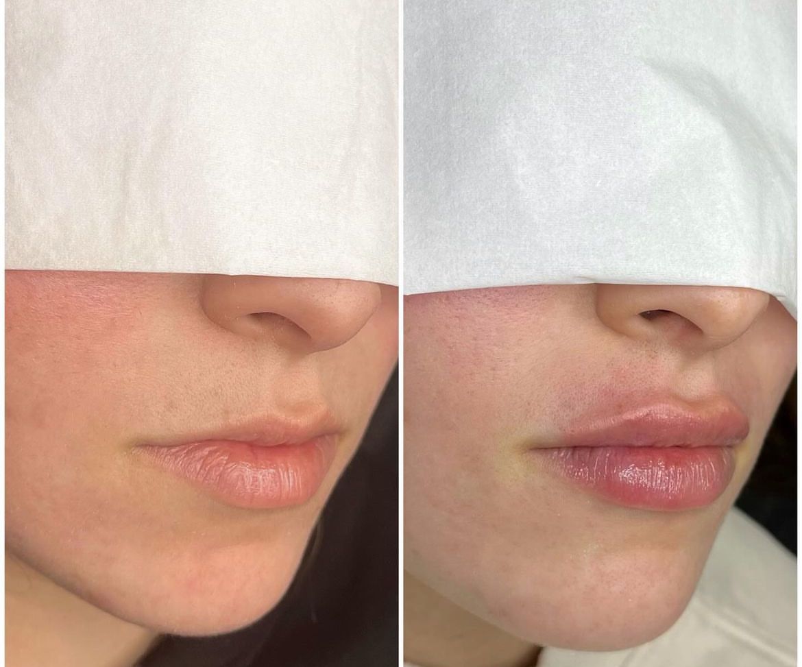 Estetica Ramos relleno labios